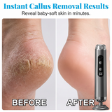 Moonval Electric Foot File, 5-Speed Rechargeable Callus Remover for Smooth Foot Care